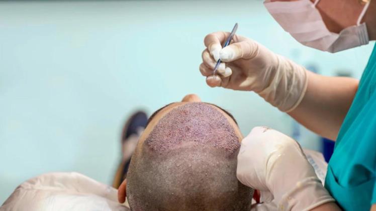 Hair Transplant in Albania